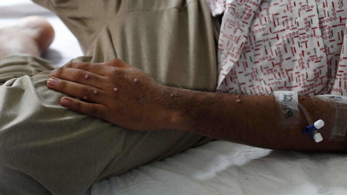 Confirman segunda muerte por viruela del mono en Chile : Noticias de